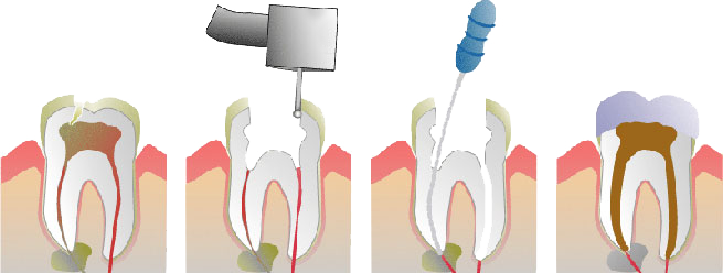 Root Canal Therapy in Grand Rapids