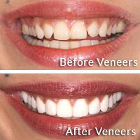Cosmetic Dentistry - Porcelain Veneers